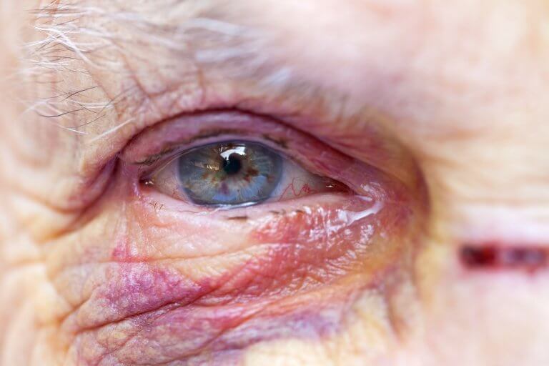 Close up picture of an elderly woman's injured eye and face - domestic violence